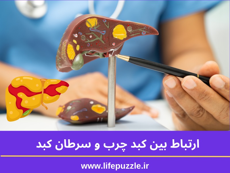 ارتباط کبد چرب با سرطان: کبد چرب میتواند منجر به سرطان شود؟ 2 ارتباط کبد چرب با سرطان
