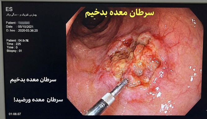 عکس سرطان معده بدخیم