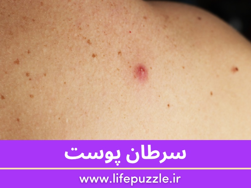 سرطان پوست
