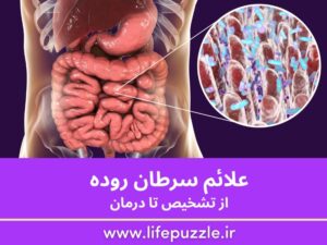 سرطان روده (کولون) چیست؟ علائم، علت و درمان قطعی [1404]