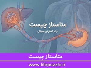 متاستاز چیست؟ راهنمای جامع سرطان متاستاتیک